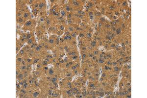 Immunohistochemistry of Human gastric cancer using CYP17A1 Polyclonal Antibody at dilution of 1:30 (CYP17A1 antibody)