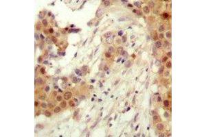 Immunohistochemical analysis of AKT2 (pS474) staining in human breast cancer formalin fixed paraffin embedded tissue section. (AKT2 antibody  (C-Term, pSer474))