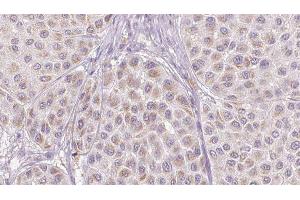 ABIN6276733 at 1/100 staining Human melanoma tissue by IHC-P. (SERPINC1 antibody  (Internal Region))