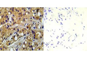 Immunohistochemical analysis of paraffin-embedded human prostate carcinoma tissue using Tsc2 (phospho-Ser1254) antibody (E012048). (Tuberin antibody  (pSer1254))
