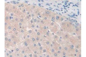 IHC-P analysis of Human Liver cancer Tissue, with DAB staining. (GALC antibody  (AA 375-535))