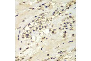 Immunohistochemistry of paraffin-embedded human kidney cancer using CHEK1 antibody. (CHEK1 antibody)