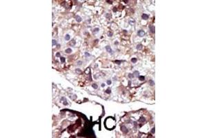Formalin-fixed and paraffin-embedded human cancer tissue reacted with the primary antibody, which was peroxidase-conjugated to the secondary antibody, followed by AEC staining. (SPHK2 antibody  (N-Term))