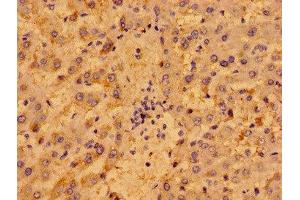 Immunohistochemistry of paraffin-embedded human liver cancer using ABIN7162453 at dilution of 1:100 (P2RY1 antibody  (AA 329-373))