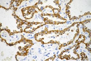 Immunohistochemistry was performed on paraffin-embedded human lung adenocarcinoma using keratin 7 antibody (ABIN7799188), 1:200). (Recombinant Cytokeratin 7 antibody)