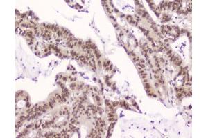 IHC testing of FFPE human intestinal cancer with XPO1 antibody at 2ug/ml. (XPO1 antibody  (AA 966-1071))