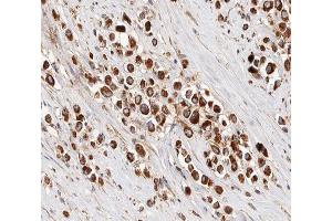 ABIN6266856 at 1/100 staining human Breast cancer tissue sections by IHC-P. (IRX2 antibody  (Internal Region))