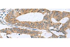 Immunohistochemistry of paraffin-embedded Human colorectal cancer tissue using HPCAL1 Polyclonal Antibody at dilution of 1:70(x200) (HPCAL1 antibody)