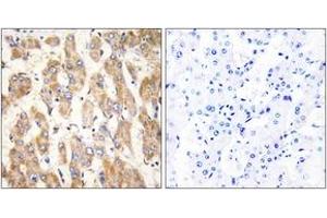 Immunohistochemistry analysis of paraffin-embedded human liver carcinoma, using BAX Antibody.