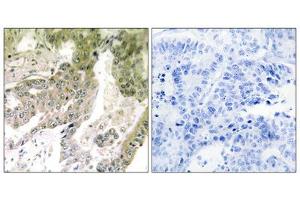 Immunohistochemistry analysis of paraffin-embedded human lung carcinoma tissue using LAMA5 antibody.
