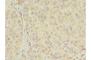 Immunohistochemistry of paraffin-embedded human liver cancer using ABIN7155026 at dilution of 1:100 (SERPIND1 antibody  (AA 20-290))