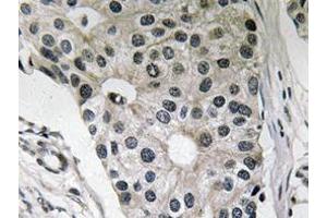 Immunohistochemistry analyzes of Ob antibody in paraffin-embedded human breast carcinoma tissue. (Leptin antibody)