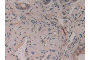 Detection of GAP43 in Human Pancreatic cancer Tissue using Polyclonal Antibody to Growth Associated Protein 43 (GAP43) (GAP43 antibody  (AA 1-274))