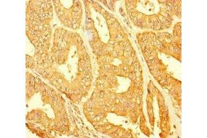Immunohistochemistry of paraffin-embedded human endometrial cancer using ABIN7147689 at dilution of 1:100