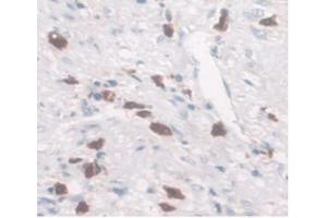 DAB staining on IHC-P Samples:Human Rectum Cancer Tissue. (SLC40A1 antibody  (AA 127-321))
