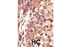 Formalin-fixed and paraffin-embedded human hepatocellular carcinoma tissue reacted with CREB3L1 polyclonal antibody  , which was peroxidase-conjugated to the secondary antibody, followed by DAB staining. (CREB3L1 antibody  (C-Term))