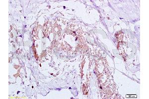 Formalin-fixed and human breast carcinoma tissue labeled with Anti-GTPBP10 Polyclonal Antibody (ABIN750748), Unconjugated at 1:200 followed by conjugation to the secondary antibody and DAB staining (GTPBP10 antibody  (AA 151-250))