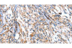 Immunohistochemistry of paraffin-embedded Human esophagus cancer using APOBEC3D Polyclonal Antibody at dilution of 1:80 (APOBEC3D antibody)