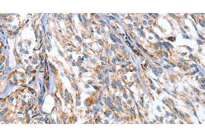 Immunohistochemistry of paraffin-embedded Human esophagus cancer using APOBEC3D Polyclonal Antibody at dilution of 1:80 (APOBEC3D antibody)