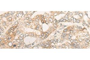 Immunohistochemistry of paraffin-embedded Human liver cancer tissue using DUOX2 Polyclonal Antibody at dilution of 1:40(x200) (DUOX2 antibody)
