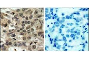 Immunohistochemistry analysis of paraffin-embedded human breast carcinoma tissue, using CDC25C (Ab-216) Antibody. (CDC25C antibody  (AA 183-232))