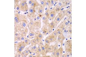 Immunohistochemistry of paraffin-embedded human liver cancer using TXNRD2 antibody at dilution of 1:100 (x40 lens). (TXNRD2 antibody)