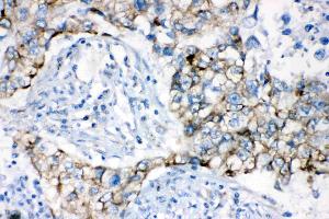 AK2 was detected in paraffin-embedded sections of human lung cancer tissues using rabbit anti- AK2 Antigen Affinity purified polyclonal antibody (Catalog # ) at 1 µg/mL. (Adenylate Kinase 2 antibody  (AA 161-239))