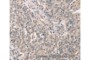 Immunohistochemistry of Human cervical cancer using CDK12 Polyclonal Antibody at dilution of 1:30 (CDK12 antibody)