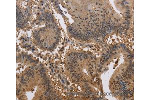 Immunohistochemistry of Human liver cancer using JAG2 Polyclonal Antibody at dilution of 1:30 (JAG2 antibody)