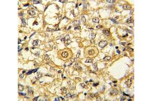 IHC analysis of FFPE human breast carcinoma stained with PDGFR beta antibody