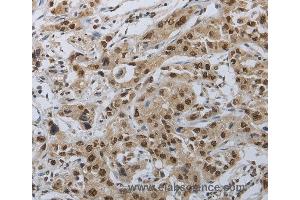 Immunohistochemistry of Human lung cancer using PRKAR1B Polyclonal Antibody at dilution of 1:70
