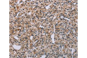 Immunohistochemistry of Human lung cancer using PNPT1 Polyclonal Antibody at dilution of 1:40