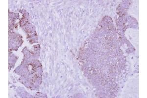 IHC-P Image Immunohistochemical analysis of paraffin-embedded human colon carcinoma, using Arginase II, antibody at 1:250 dilution. (ARG2 antibody  (Center))