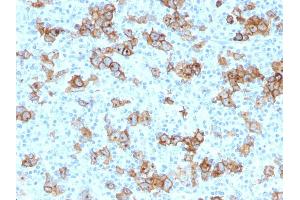 Formalin-fixed, paraffin-embedded human Hodgkin's Lymphoma stained with CD30 Monoclonal Antibody (Ki-1/779). (TNFRSF8 antibody)
