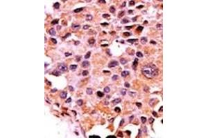 Formalin-fixed and paraffin-embedded human cancer tissue reacted with the primary antibody, which was peroxidase-conjugated to the secondary antibody, followed by AEC staining. (PPP3CA antibody  (N-Term))