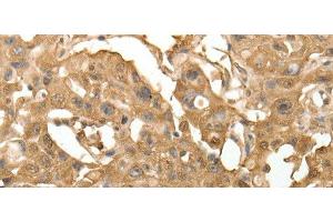 Immunohistochemistry of paraffin-embedded Human lung cancer using TXN Polyclonal Antibody at dilution of 1:40 (TXN antibody)