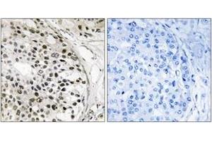 Immunohistochemistry analysis of paraffin-embedded human breast carcinoma tissue, using MNK1 (Ab-250) Antibody.