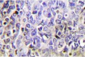 Immunohistochemistry analysis of Granzyme K in paraffin-embedded human lung carcinoma tissue. (GZMK antibody)