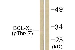 Immunohistochemistry analysis of paraffin-embedded human lung carcinoma tissue using BCL-XL (Phospho-Thr47) antibody. (BCL2L1 antibody  (pThr47))