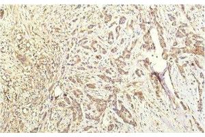 Immunohistochemistry of paraffin-embedded Human breast carcinoma tissue using STAT1 Monoclonal Antibody at dilution of 1:200. (STAT1 antibody)