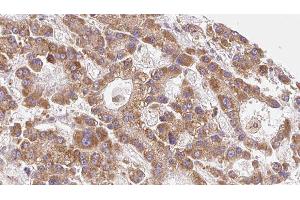 ABIN6279547 at 1/100 staining Human liver cancer tissue by IHC-P. (SLC16A6 antibody)