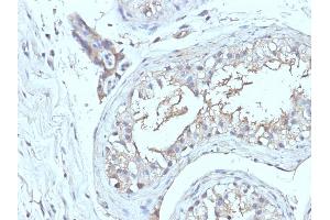 Formalin-fixed, paraffin-embedded human Testicular Ca stained with CD63 Monoclonal Antibody (NKI/C3 + LAMP3/968) (CD63 antibody)