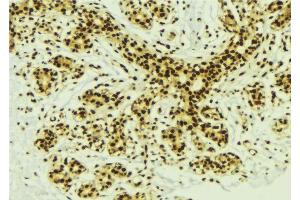 ABIN6277629 at 1/100 staining Human breast cancer tissue by IHC-P. (PRDM14 antibody  (N-Term))