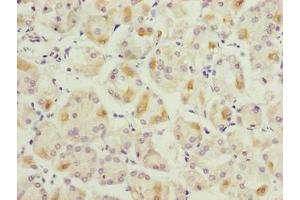 Immunohistochemistry of paraffin-embedded human gastric cancer using ABIN7158732 at dilution of 1:100 (LYSMD1 antibody  (AA 1-227))