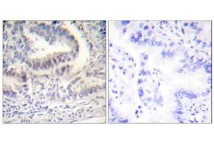 Immunohistochemical analysis of paraffin-embedded human lung carcinoma tissue using Lamin A (Cleaved-Asp230) Antibody (ABIN5978456). (Lamin A/C antibody  (Cleaved-Asp230, Internal Region))