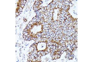 Immunohistochemistry of paraffin-embedded human Colon cancer using C2 Rabbit pAb (ABIN7265549) at dilution of 1:100 (40x lens). (AKR1C2 antibody  (AA 1-323))