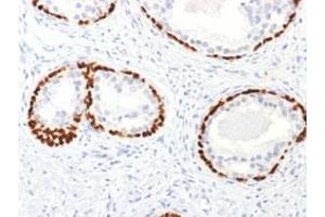 Immunohistochemical staining (Formalin-fixed paraffin-embedded sections) of human prostate cancer with TP63 polyclonal antibody . (p63 antibody)