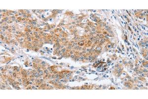 Immunohistochemistry of paraffin-embedded Human gastric cancer using CRELD2 Polyclonal Antibody at dilution of 1:50 (CRELD2 antibody)