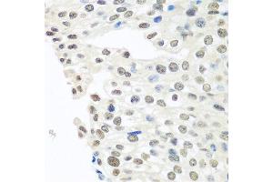 Immunohistochemistry of paraffin-embedded human prostate cancer using TARDBP antibody at dilution of 1:100 (40x lens).