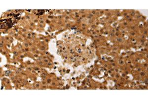 Immunohistochemistry of paraffin-embedded Human ovarian cancer tissue using JUND Polyclonal Antibody at dilution 1:60 (JunD antibody)